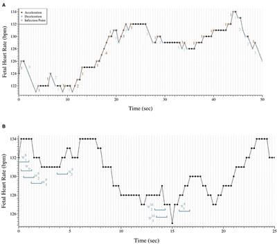 Fetal Heart Rate Fragmentation